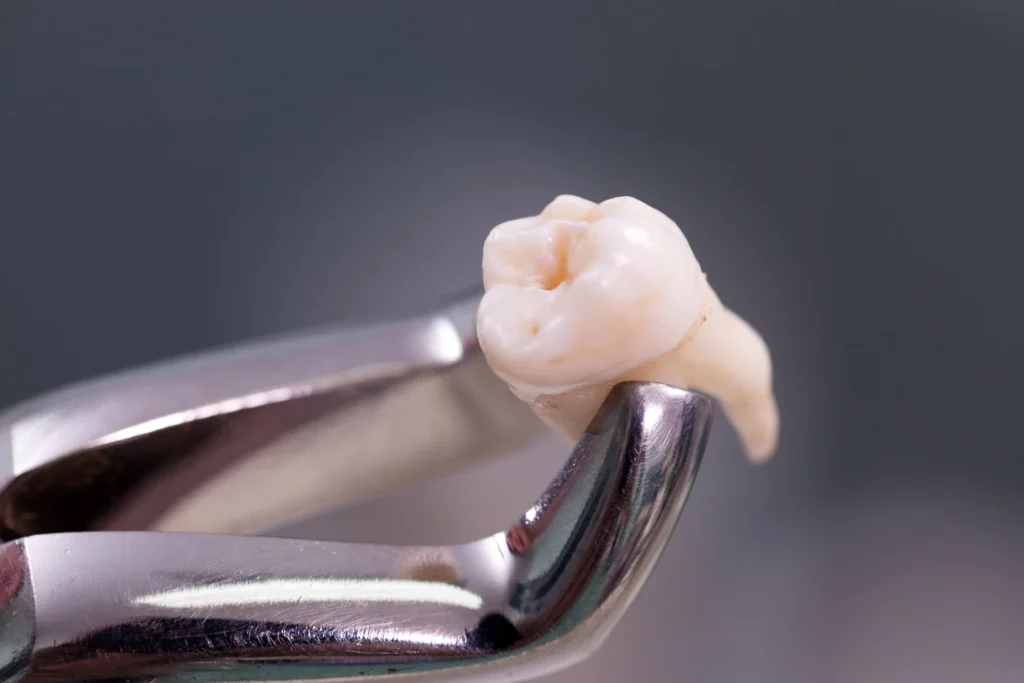 Tooth extraction services Black Pine Oral Surgery Boise